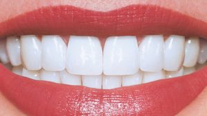 Cât de nocive sunt plombele dentare cu amalgam