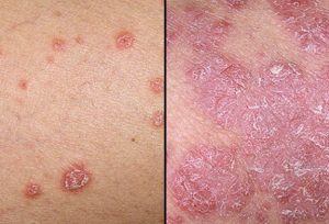 Read more about the article Vindecă psoriazisul cu turmeric!